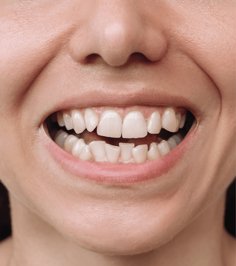 Teeth before treatment